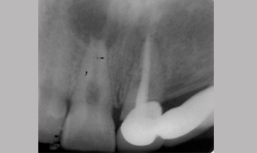 Root canal treatment in Anand                        